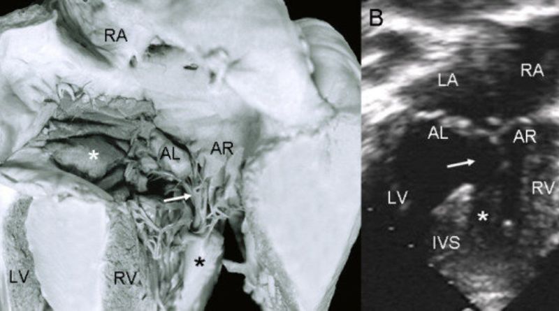 Rastelli Designation AV Valve: A Comprehensive Overview